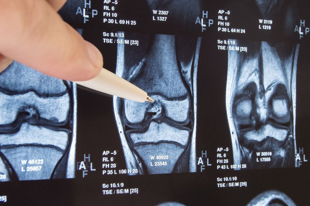 Knee Arthritis & Replacement Orthopedic Centers of Colorado